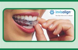 Aparelho Invisalign